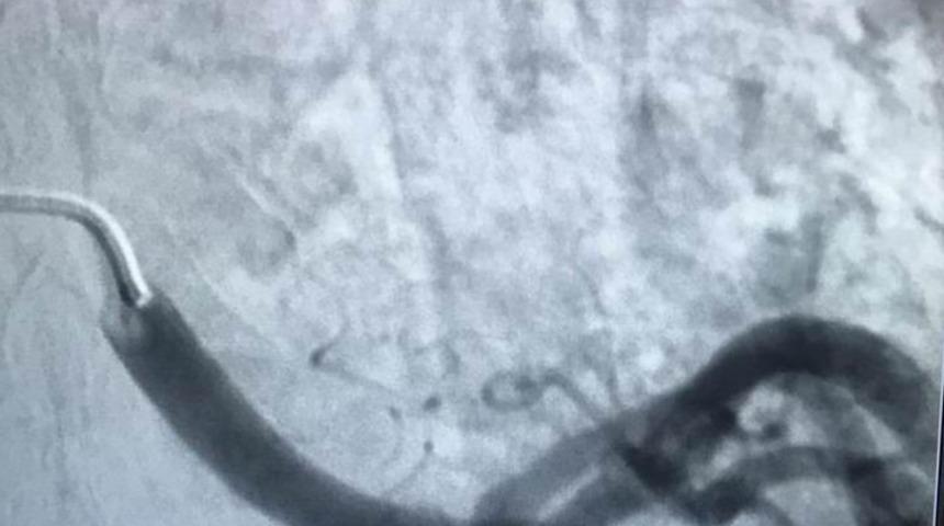 Bu y&ouml;ntem ile ameliyata gerek kalmıyor