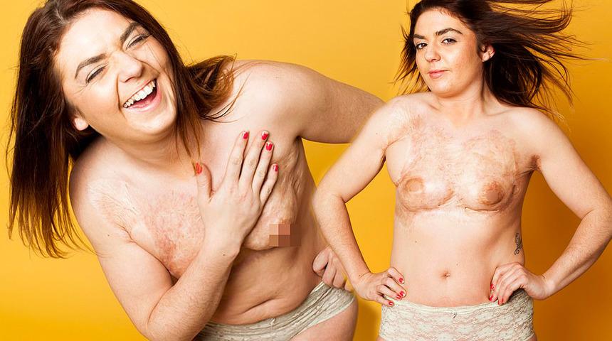 G&ouml;ğs&uuml; yandı, 60'tan fazla ameliyat oldu! V&uuml;cudunu sevmeyi &ouml;ğrenince &ccedil;ıplak poz verdi