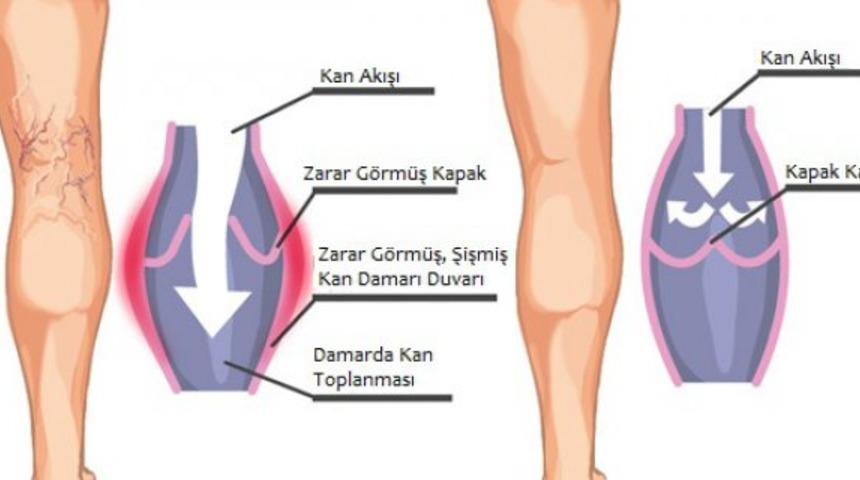 Derin ven trombozu riskli midir?