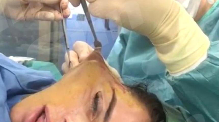 Bunu da g&ouml;rd&uuml;k! &Uuml;nl&uuml; isim y&uuml;z germe ameliyatının videosunu paylaştı