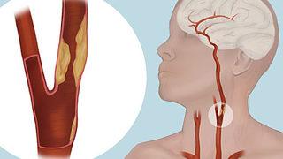 İnme nedir? İnme tedavisinde ilk 1 haftalık sürece dikkat!