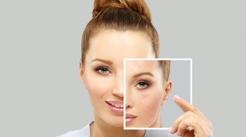 Yanık/yara izi tedavisinde son gelişmeler