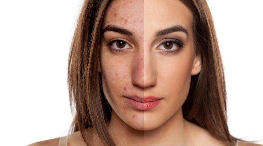 Kırışıklara ve problemli cilde veda etmek i&ccedil;in en kolay &ccedil;&ouml;z&uuml;m