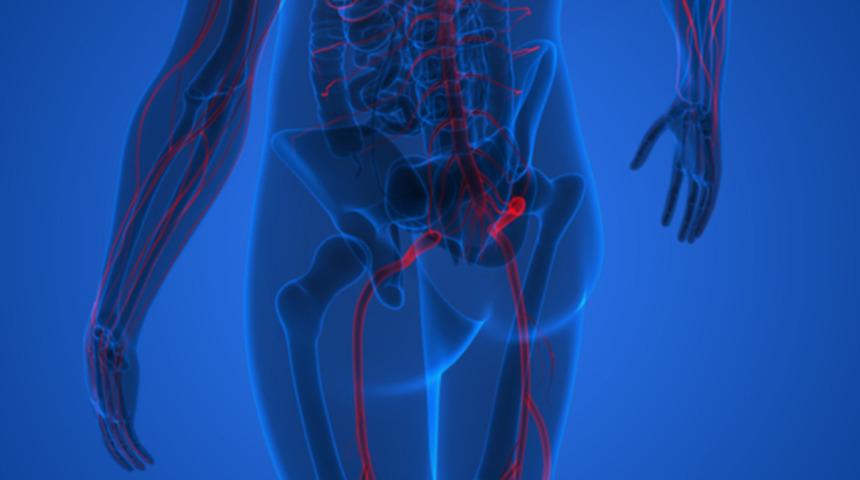 Siyatik sinir endometriozisi nedir, neden olur, belirtileri ve tedavi yöntemleri nelerdir?