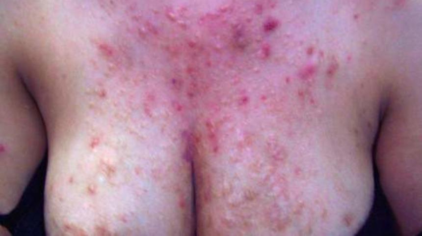 Onlardan kurtulamıyoruz! Göğsünüzde sivilceleriniz varsa nedeni bu olabilir