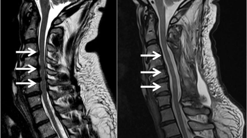 MILD Nedir? Omurga kanal darlığı nasıl tedavi edilir?
