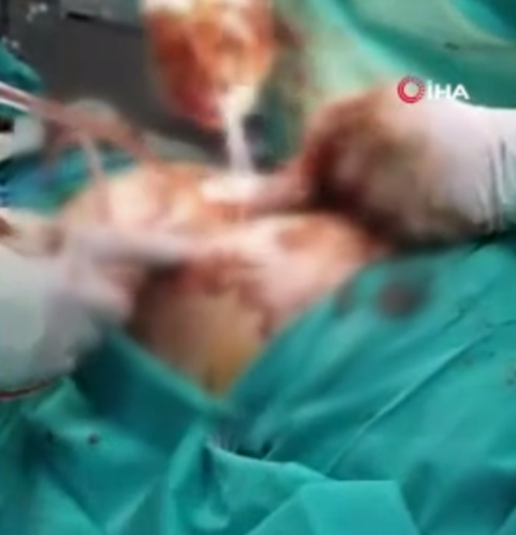 Midesinden çıkanlar doktorları bile şaşırttı! Tam 700 gram G2