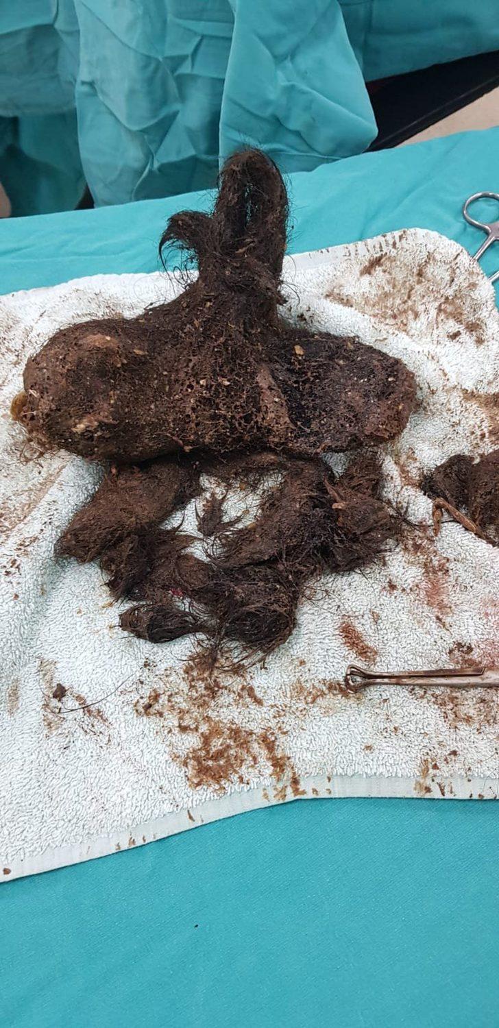 Midesinden çıkanlar doktorları bile şaşırttı! Tam 700 gram G5