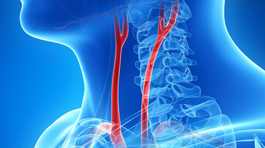 Karotis arter (şah damarı) hastalığının belirtileri ve tedavi şekli 