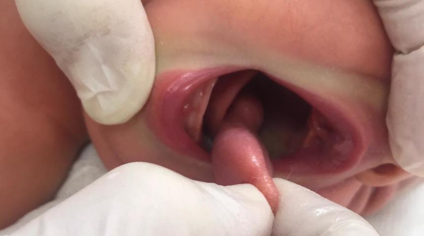 '&Ccedil;ift dilli' doğan Zeynep bebeğin ikinci dili ameliyatla alındı