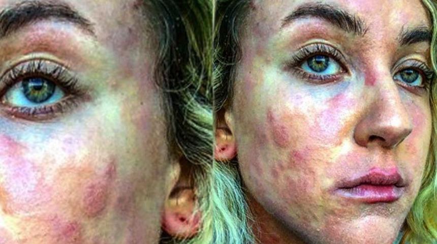 Sedef hastalığının çözümü bu doğal yollarda yatıyor! İşte denenmiş 9 çözüm 