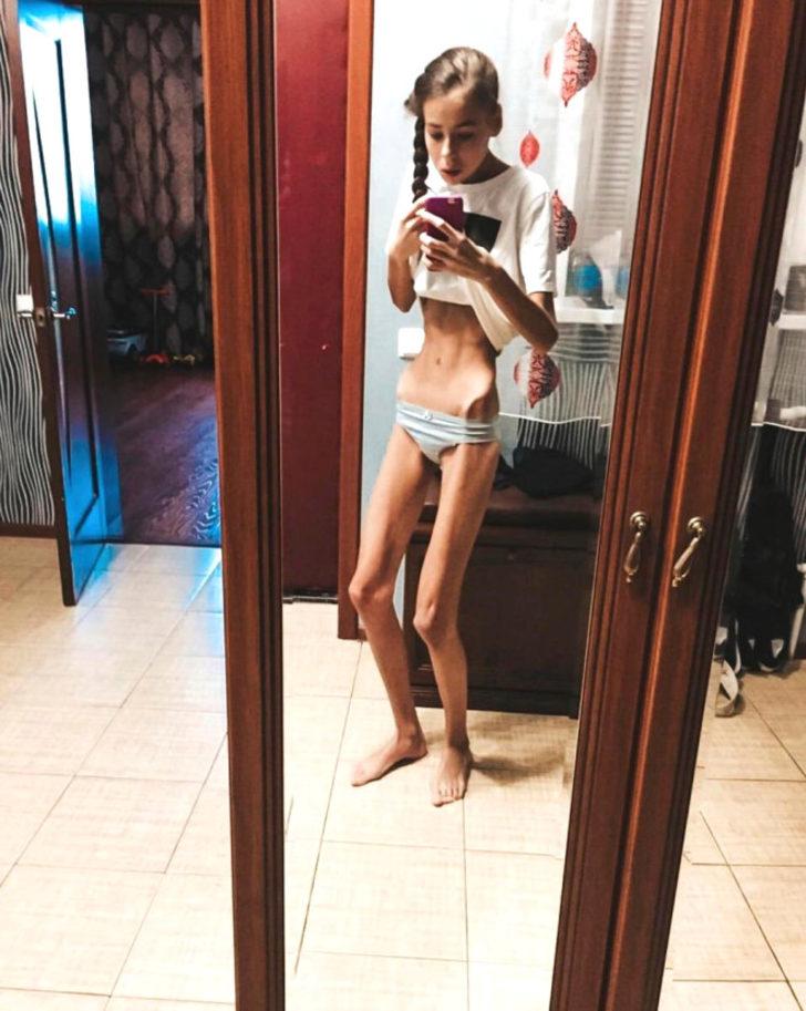 'Daha çok zayıflamalısınız' Bu söz canından ediyordu! G2