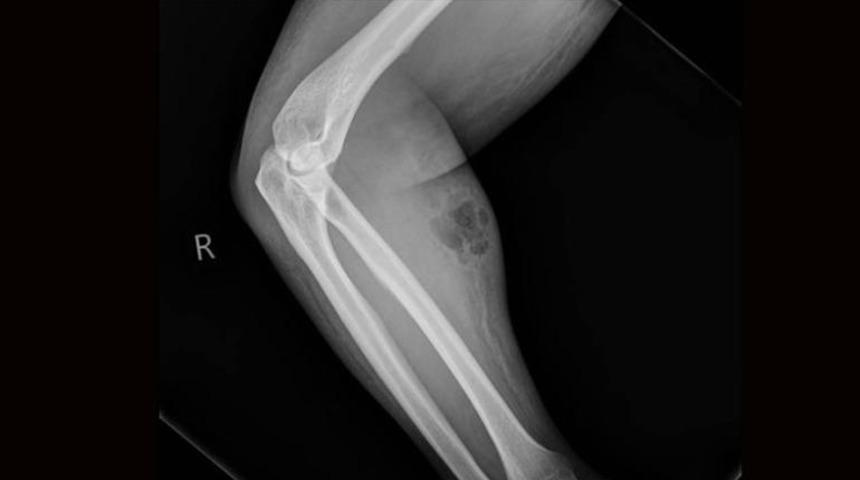 18 ay boyunca koluna sperm enjekte etti! 