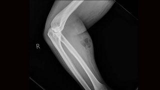 18 ay boyunca koluna sperm enjekte etti! 