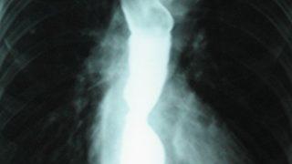 Akalazya nedir? Bu belirtiler sizde de varsa...