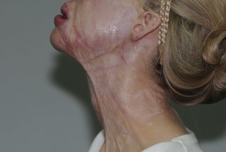 Eski sevgilisi tecavüz edip yüzüne asit fırlattı! 10 years challenge fotoğrafı şok etti G1