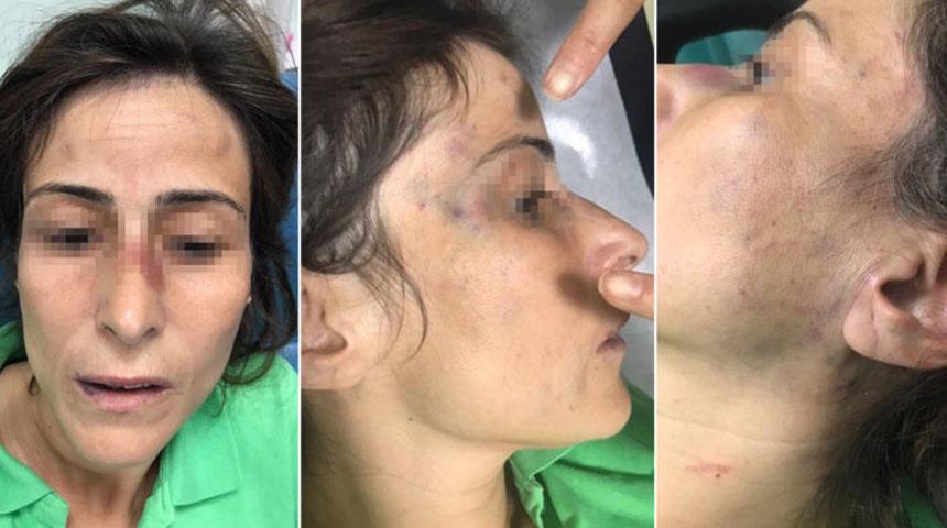 Ankara'da doktor çiftin şiddet davasında flaş gelişme! İşte eşinin kemiklerini kıran doktorun cezası...