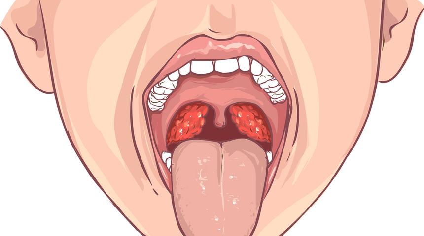 Kronik farenjit nedir? Kronik farenjit sebepleri nelerdir Kronik farenjit nedenleri ağızdan nefes almak nasıl etkiler?