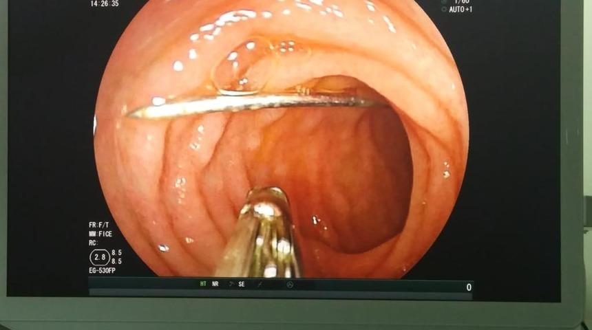 9 aylık bebek 4 santimlik iğne yuttu!