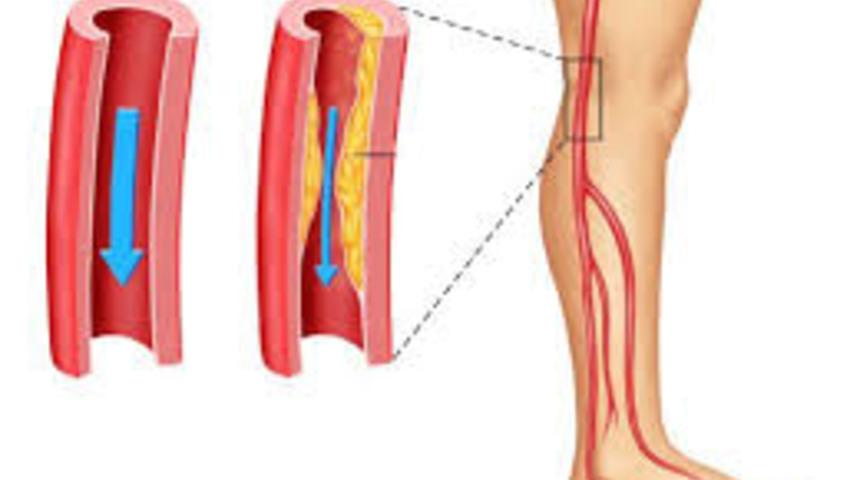 Bacak kurtaran minimal invaziv cerrahi yöntemleri