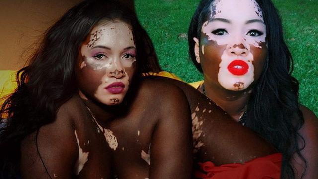 Vitiligolu model isyan etti! 'Ne yani böyleyim diye ölmem mi gerekiyor?'