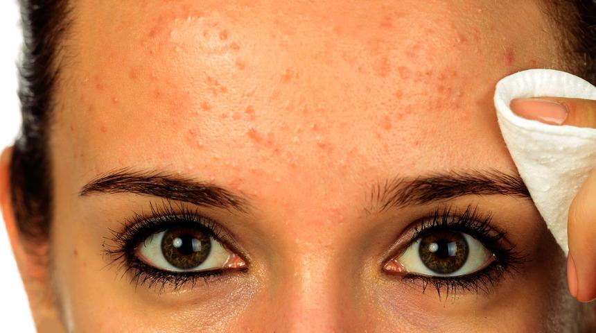  Yanaklarınızda ya da alnınızda &ccedil;ıkan sivilceler başka problemlerin habercisi olabilir