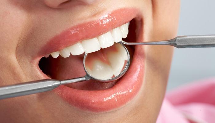 Sağlıklı diş eti nasıl olur? Diş taşı nedir, nasıl oluşur? Diş taşları