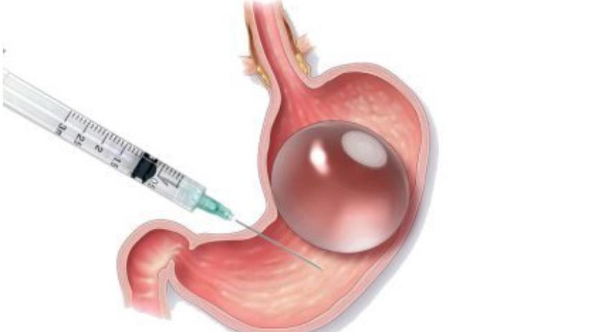 Mide botoksu nedir? Mide botoksu yaptıran hastalar nasıl bir değişim yaşıyor? Mide botoksunun zararları var mıdır?