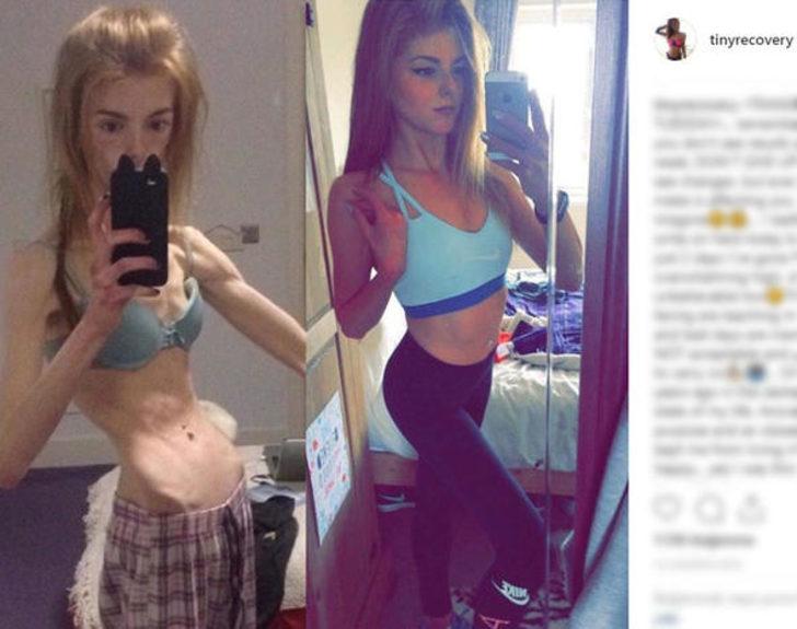 Anoreksiya hastası çikolatayla hayata döndü! İşte son hali G1