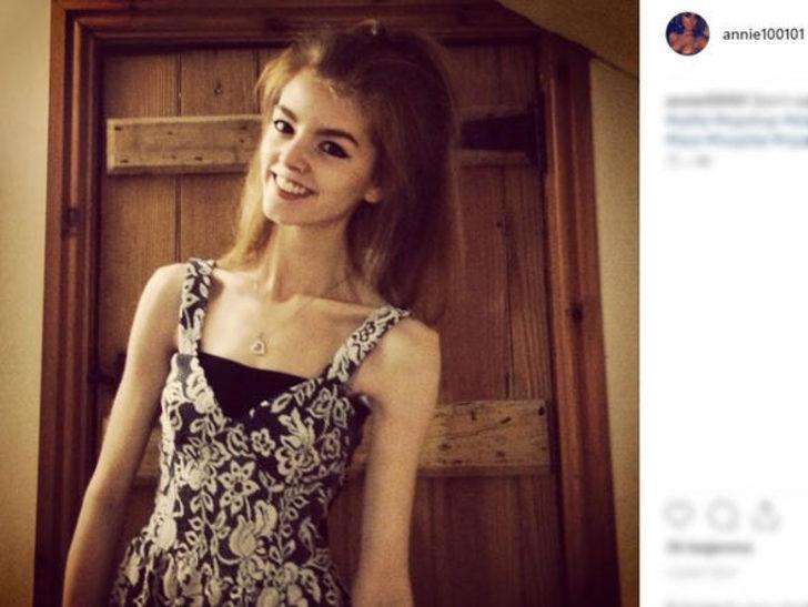 Anoreksiya hastası çikolatayla hayata döndü! İşte son hali G2