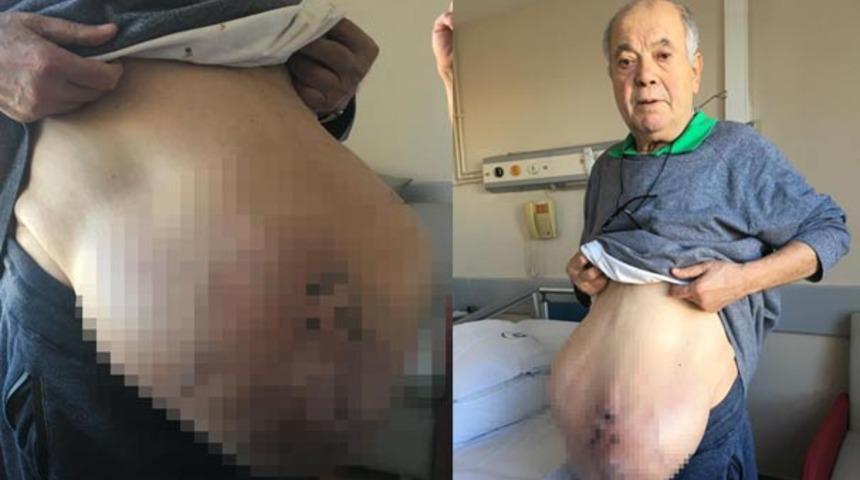 Büyüyen karnı yüzünden insan içine çıkamayan adam, çareyi Adana'da buldu!