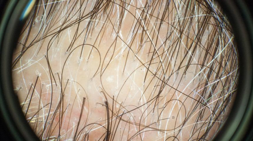 Kemik iliğini bug&uuml;ne kadar yemeklerde kullandık! Meğer sa&ccedil; d&ouml;k&uuml;lmesine karşı birebirmiş