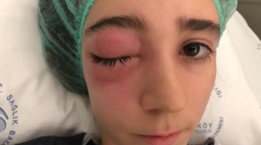 Burun akıntısıyla başladı, az daha gözünü kaybediyordu! 