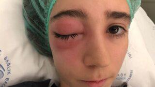 Burun akıntısıyla başladı, az daha gözünü kaybediyordu! 