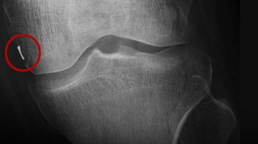 Aylarca ağrı çekti, görünce şoke oldu: Bacağında unuttular