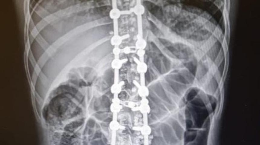 Omurga eğriliğinden kurtuldu