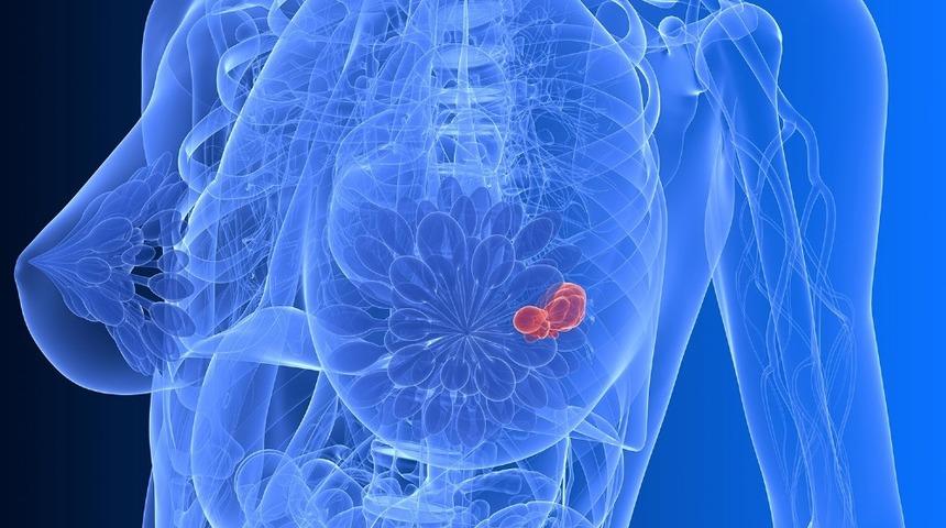 Meme kanseri en sık rastlanan kanser t&uuml;r&uuml;