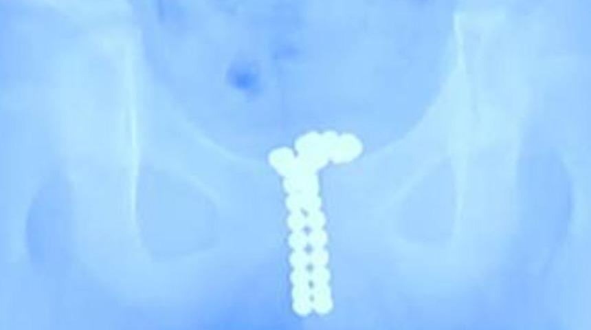 12 yaşındaki çocuğun penisinden çıkanlar şoke etti!