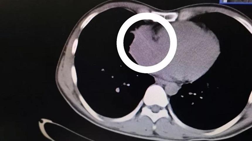 Alkol alırken yuttuğu k&uuml;rdan kalbine saplandı