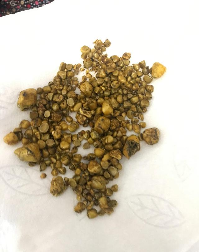 Safra kesesinden 311 taş çıktı
