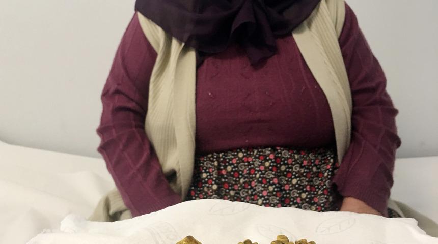 Safra kesesinden 311 taş &ccedil;ıktı