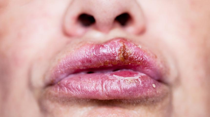 Uçuktan kurtulmanın doğal yolları