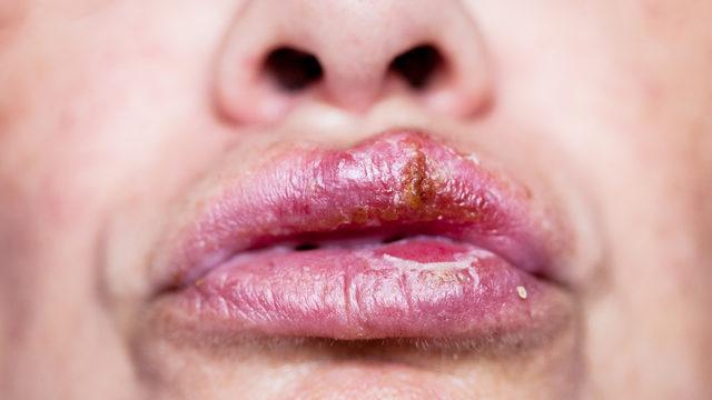 Uçuktan kurtulmanın doğal yolları