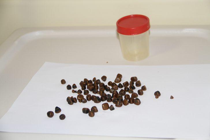 Hepsini ameliyatla çıkardılar! Tam 86 tane G2