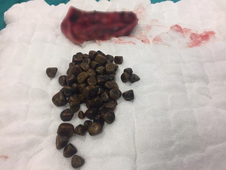 Hepsini ameliyatla çıkardılar! Tam 86 tane G4