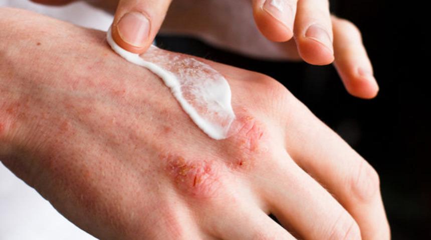 Hangi t&uuml;r yara ve yanık izleri plastik cerrahi ile silinebilir?