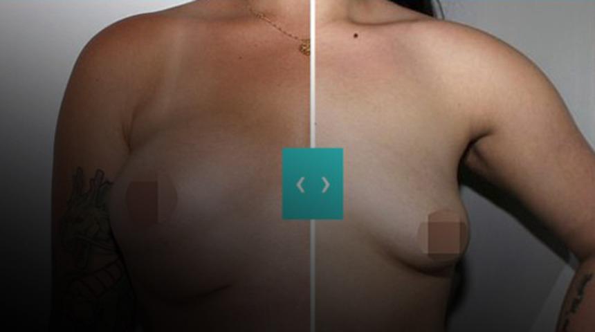 Bütün parasını göğüs estetiğine harcadı ama aynaya baktığında hayatının şokunu yaşadı