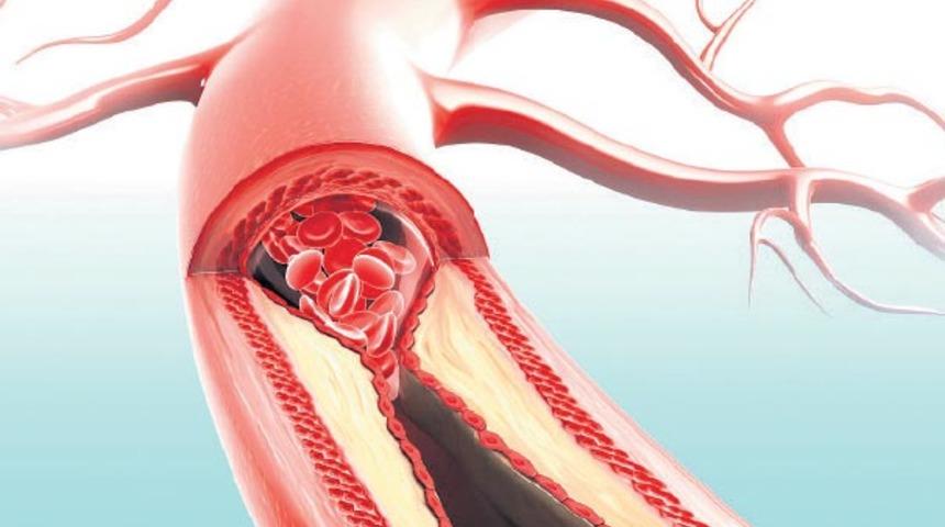 Buerger nedir? Sigara buerger hastalığını nasıl etkiler?  Buerger genç yaşta uzuv kaybına neden oluyor