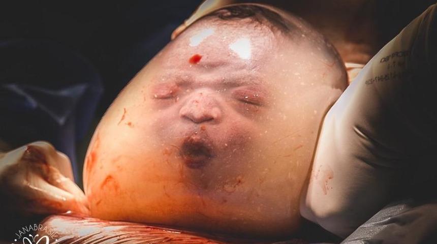 80 binde bir görülen mucize! Amniyotik kesede doğan bebeğin inanılmaz anları 