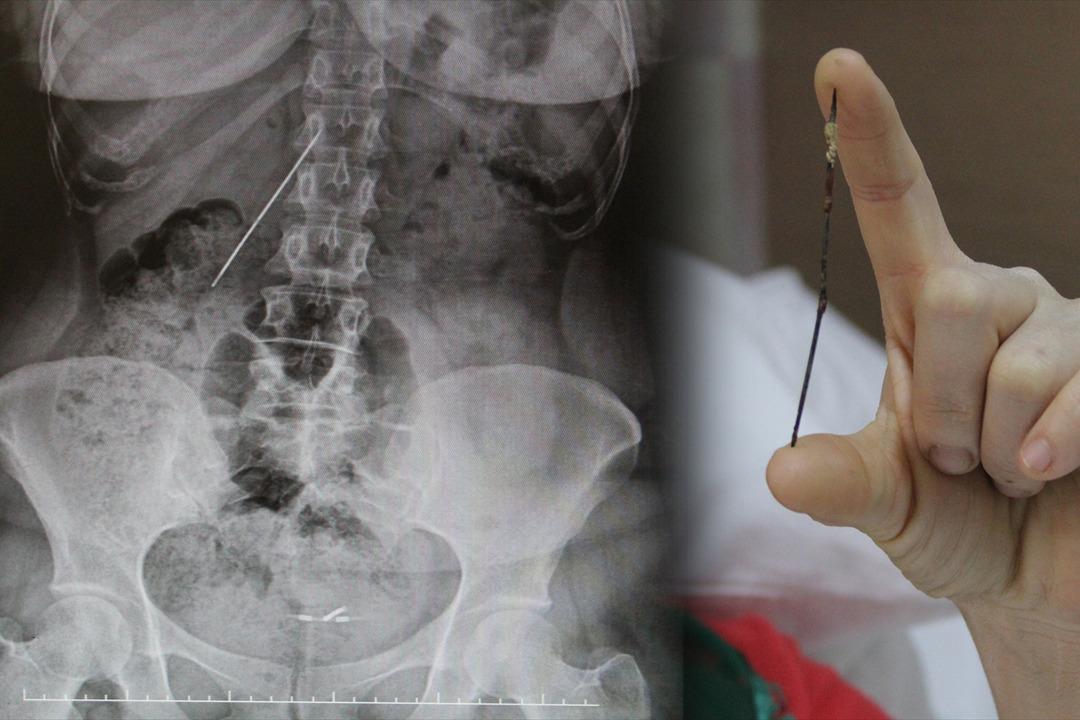 Tam 15 santimetre! Karnından 26 yıl sonra &ccedil;ıkarıldı